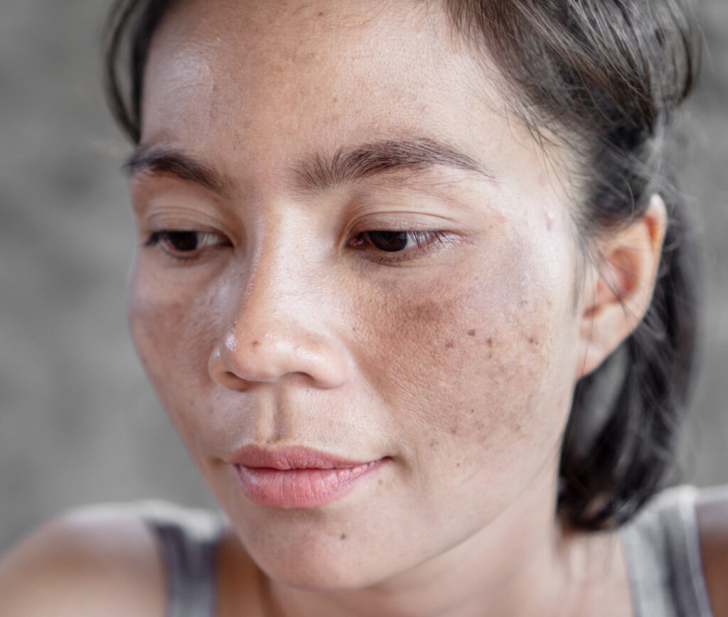 woman with uv skin damage from the sun, with visible age spots and hyperpigmentation